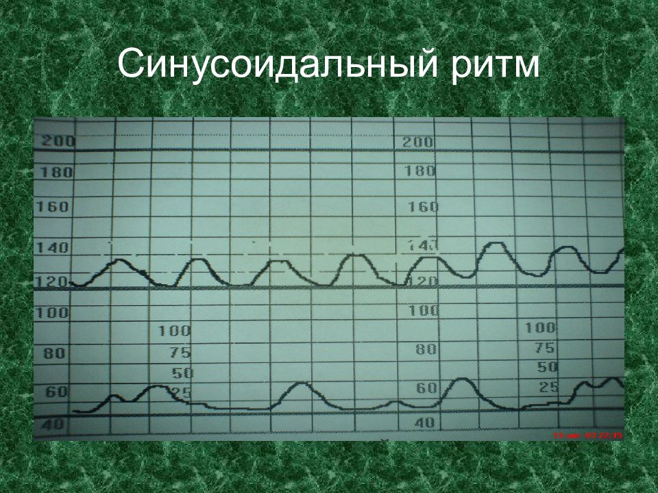 Ктг. Частота базального ритма КТГ. Вариабельность ритма КТГ. Типы кривых КТГ. Типы КТГ плода.