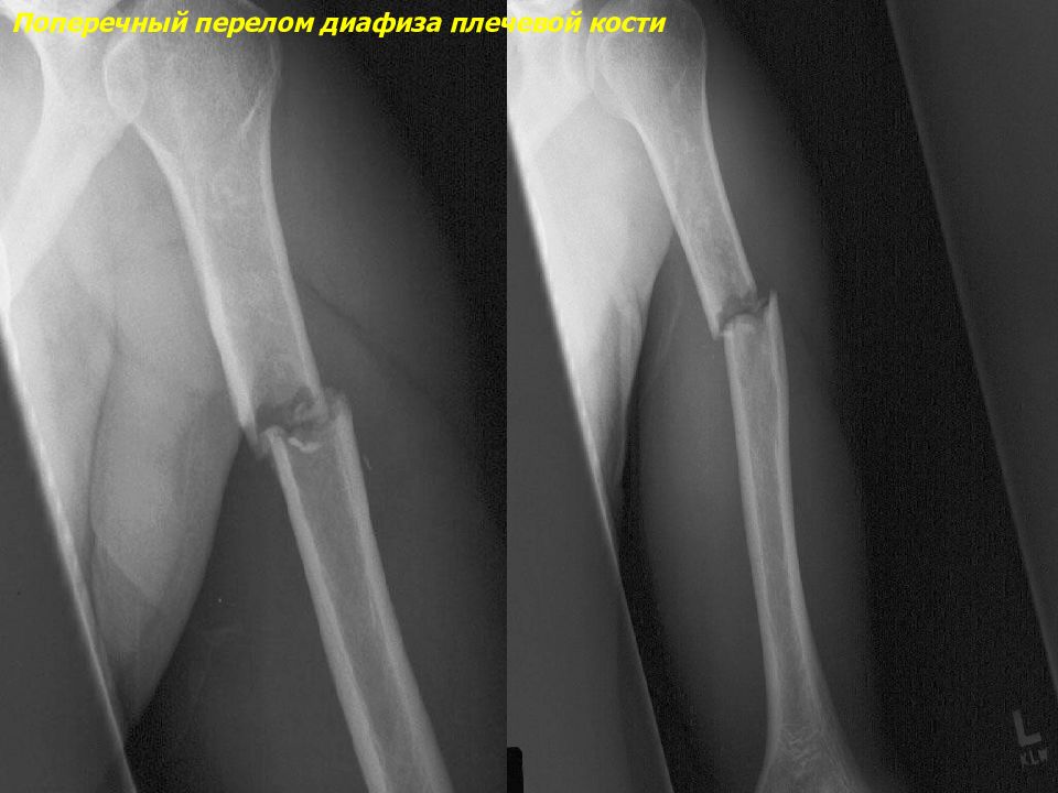 Переломы плечевой кости презентация