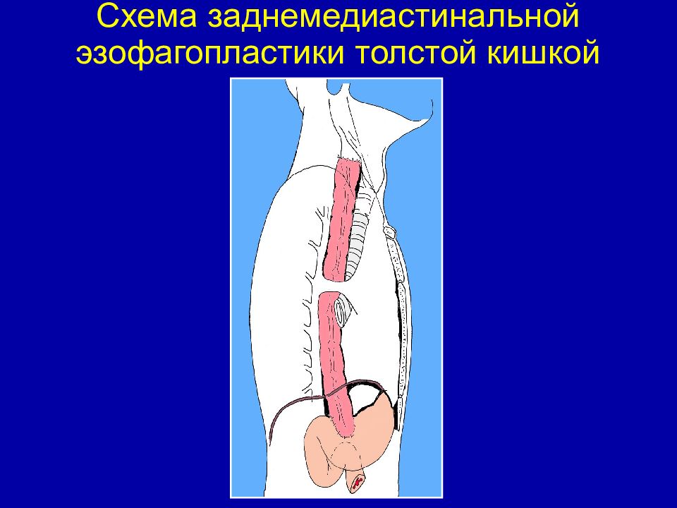 Сфинктеры толстой кишки схема