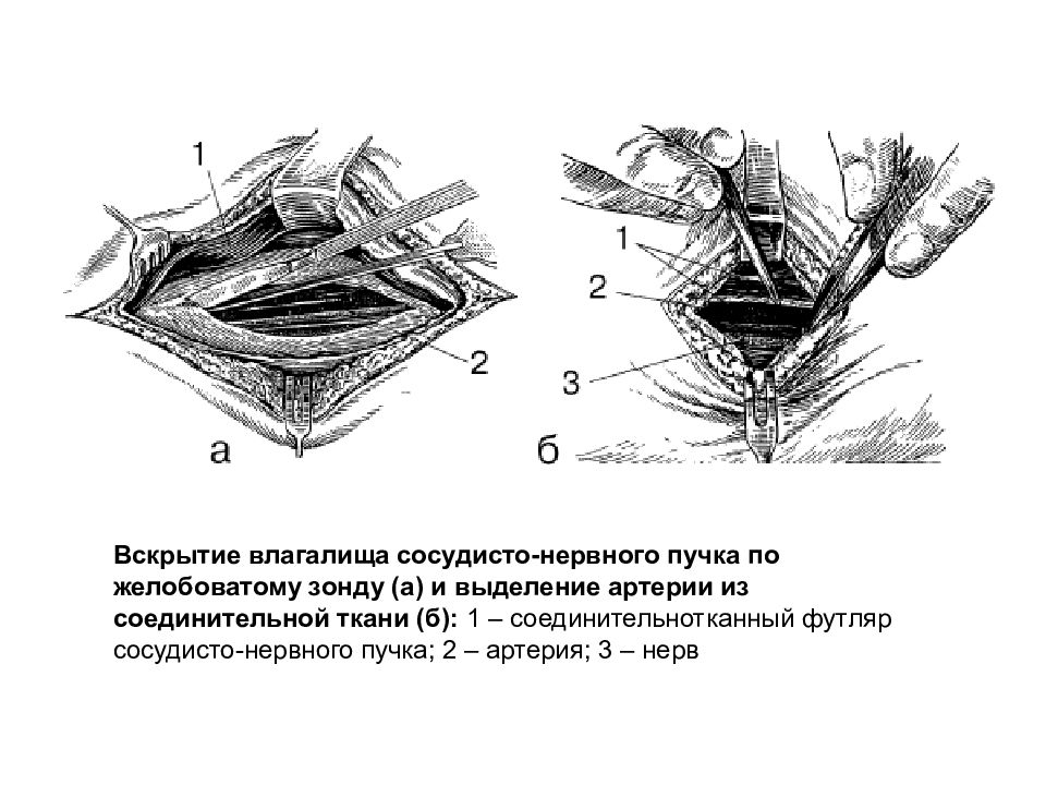 Перевязка в ране и на протяжении. Инструмент для вскрытия ложа сосудисто-нервного пучка.. Влагалище сосудисто нервного пучка. Перевязка язычной артерии. Вскрытие сосудисто нервного пучка.