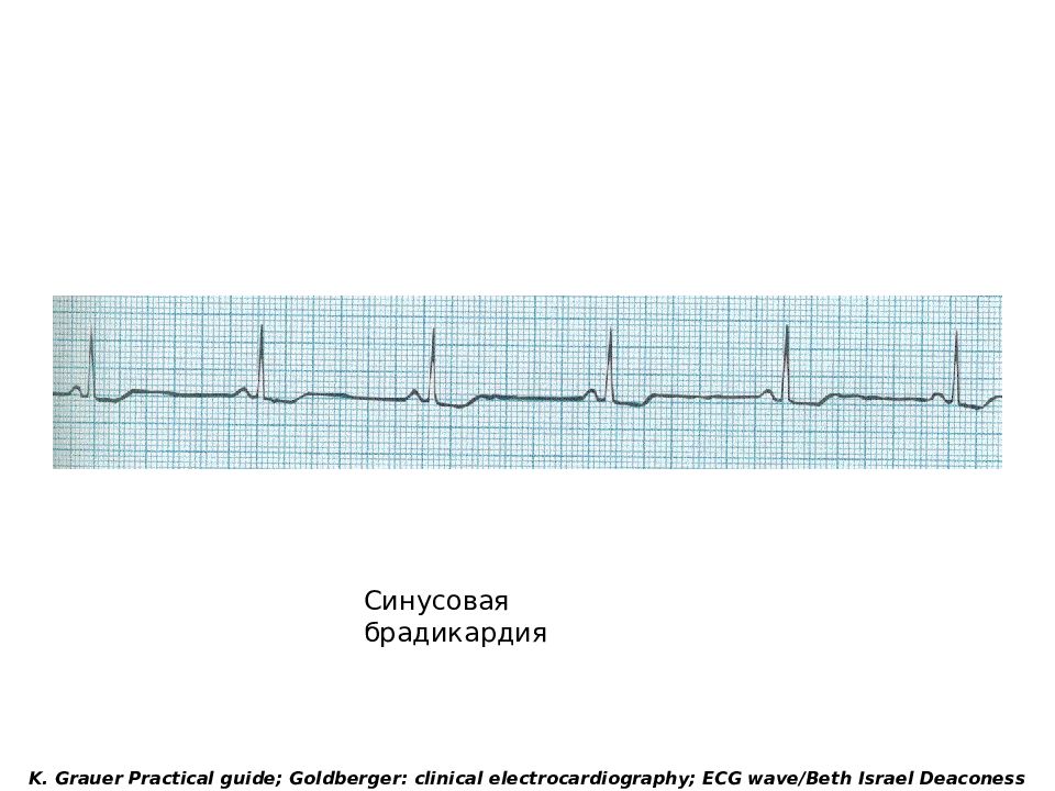 Синусоидная брадикардия. Синусовая брадикардия на ЭКГ. ЭКГ пленки синусовая брадикардия. ЭКГ при синусовой брадикардии. Синусовая брадикардия ЭКГ признаки.