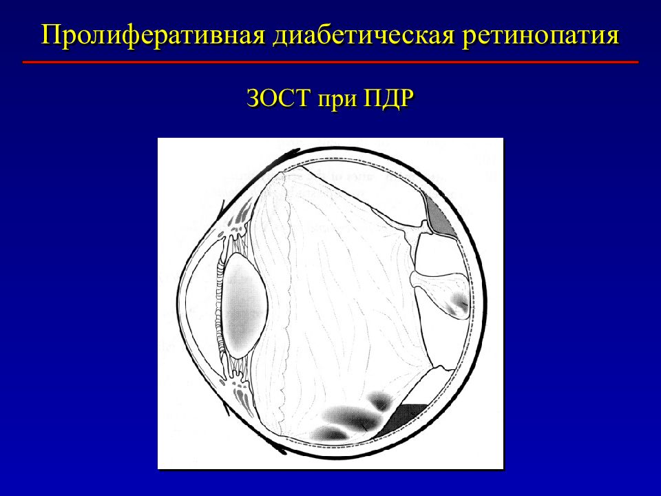 Стекловидное тело рисунок. Задняя отслойка стекловидного тела. Зост стекловидного тела. Стекловидное тело в легких.