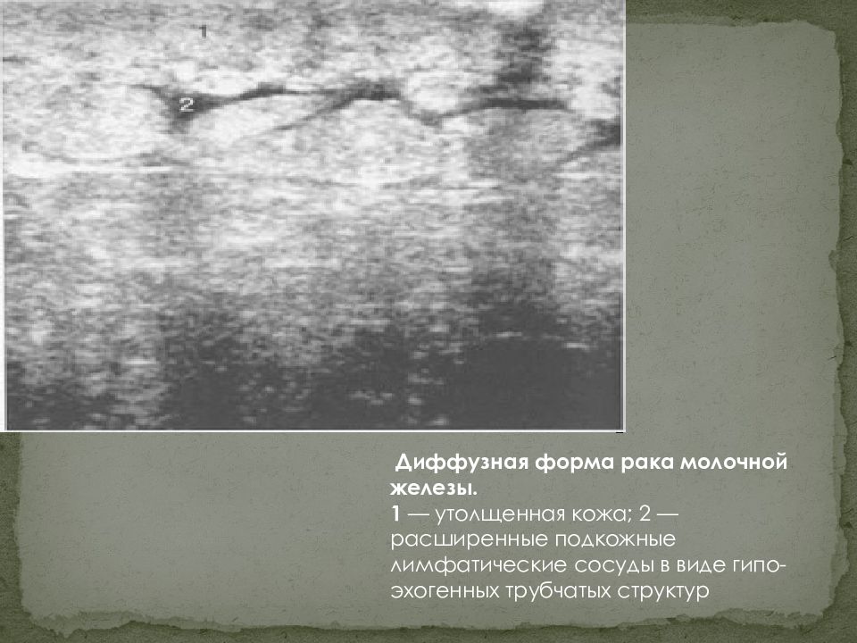 Диффузные молочная железа. Диффкщные формы ракамолочной д. Отечно-инфильтративная форма. Диффузные изменения молочных желез на УЗИ.