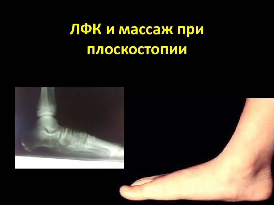ЛФК и массаж при плоскостопии