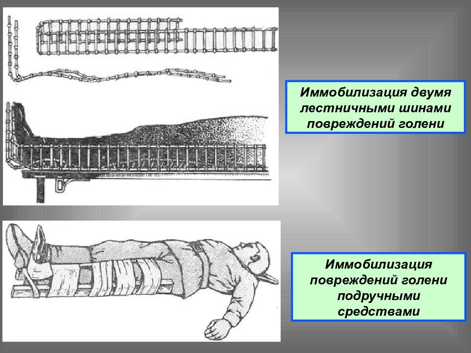 Лестничная шина для иммобилизации. Иммобилизация двумя лестничными шинами. Лестничные шины для иммобилизации. Средства иммобилизации переломов. Транспортная иммобилизация конечностей.