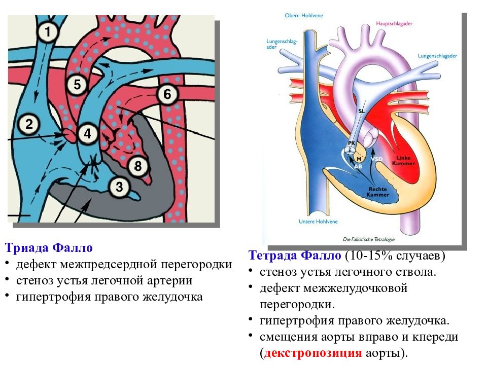 Триада фалло презентация