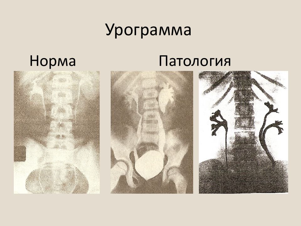 Норма и патология. Экскреторная урография норма. Урограмма норма.