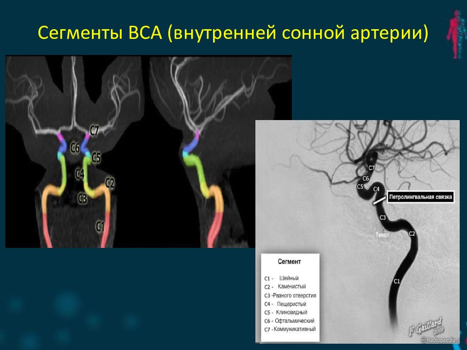 Сегменты внутренней сонной артерии