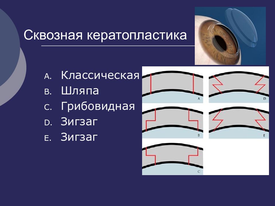 Кератопластика. Сквозная кератопластика ход операции. Сквозная послойная кератопластика. Классификация кератопластик.