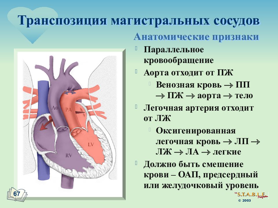 Транспозиция артерий. Транспозиция магистральных сосудов гемодинамика. Врожденный порок сердца транспозиция магистральных сосудов. Транспозиция магистральных сосудов гемодинамика схема. Транспозиция магистральных сосудов у детей гемодинамика.