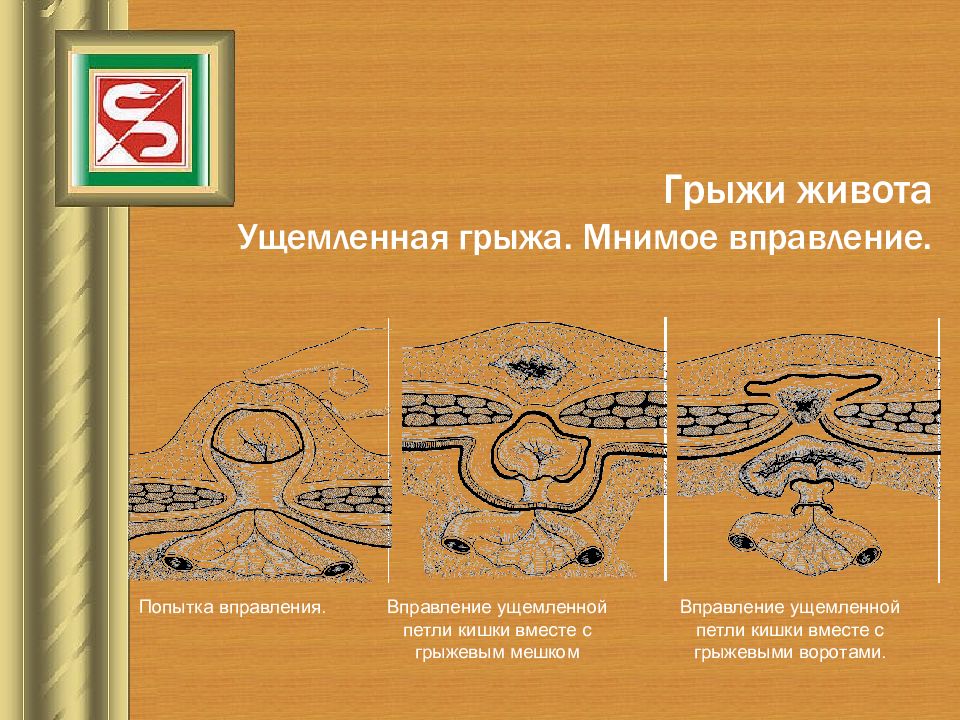 Ущемленная грыжа передней брюшной стенки карта вызова