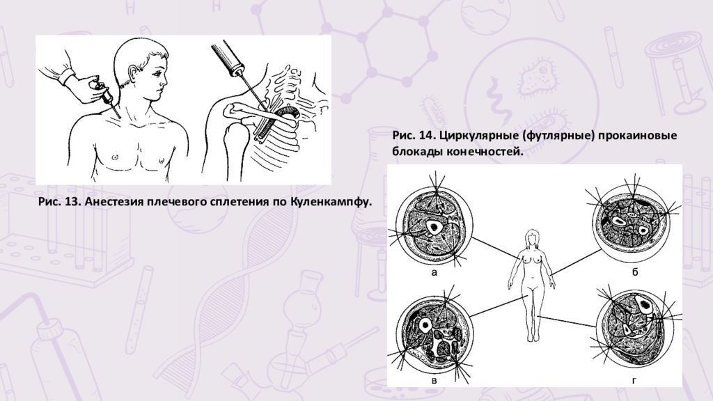 Блокада по лорин эпштейну. Футлярная блокада по Вишневскому. Футлярная новокаиновая блокада. Футлярная анестезия по Вишневскому. Блокада плечевого сплетения по Куленкампфу.