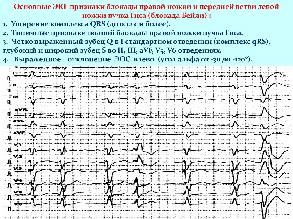 Экг при нарушениях ритма и проводимости презентация