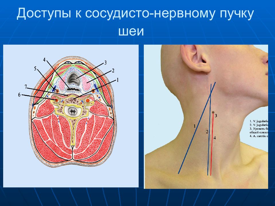 Латеральный пучок шеи