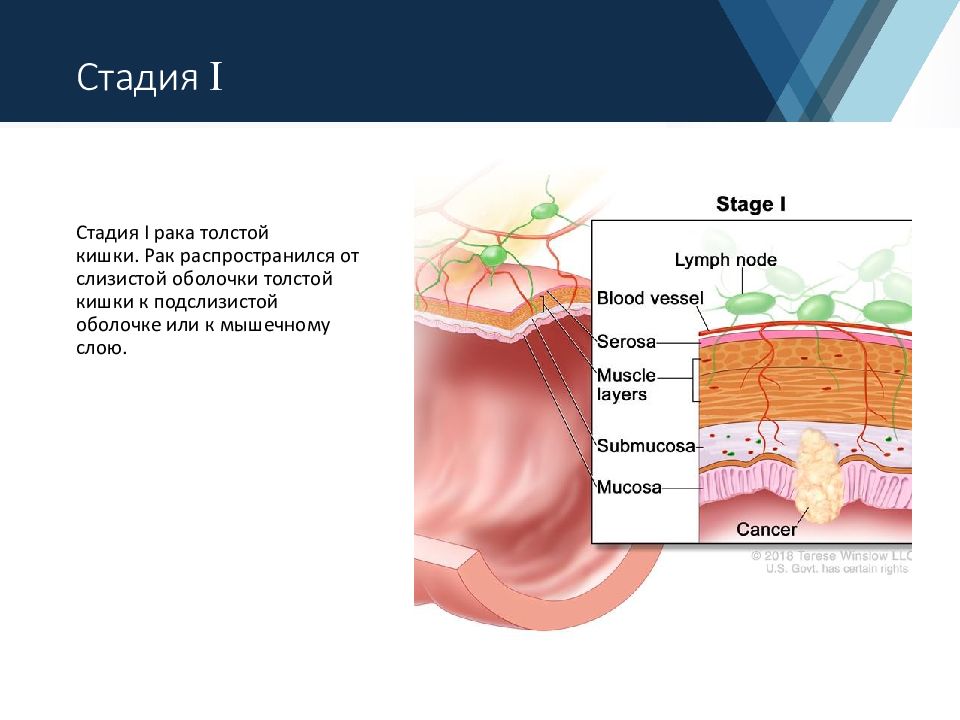 Первая стадия рака. Стадии опухоли толстой кишки. Подслизистый слой толстой кишки. Подслизистый слой толстой Кишк. Опухоль толстой кишки 3 стадия.