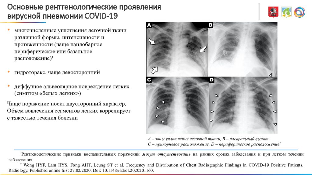 Чем отличается пневмония от ковида 19. Вирусная пневмония ковид кт. Вирусная пневмония рентген. Рентгенологические симптомы пневмонии.