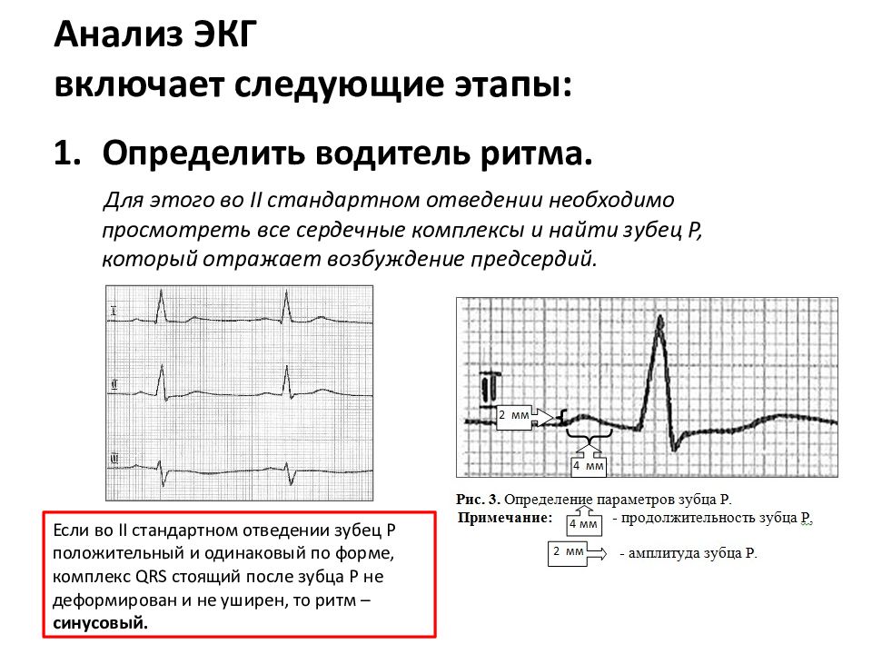 Экг исследование. Схема анализа ЭКГ кратко. Анализ стандартных отведений ЭКГ. Алгоритм анализа ЭКГ пропедевтика. Анализируемые параметры ЭКГ.