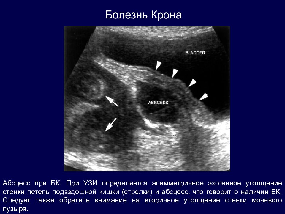 Узи кишечника взрослому