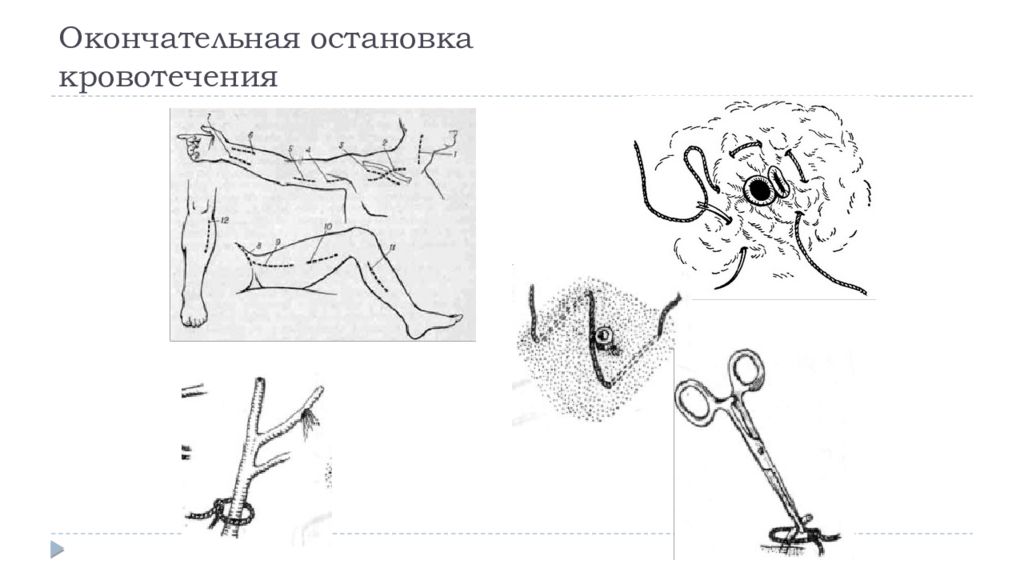 Окончательно б. Окончательная остановка кровотечения. Окончательная остановка кровотечения хирургия. Хирургические методы окончательной остановки кровотечений. Механические методы остановки кровотечения.