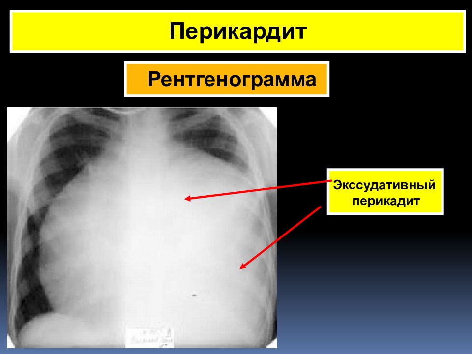 При выпотном перикардите на рентгенограмме наблюдается легочный рисунок тест ответ