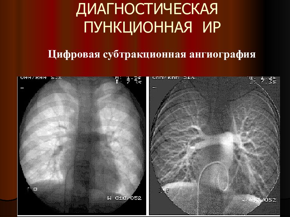 Интервенционная радиология презентация