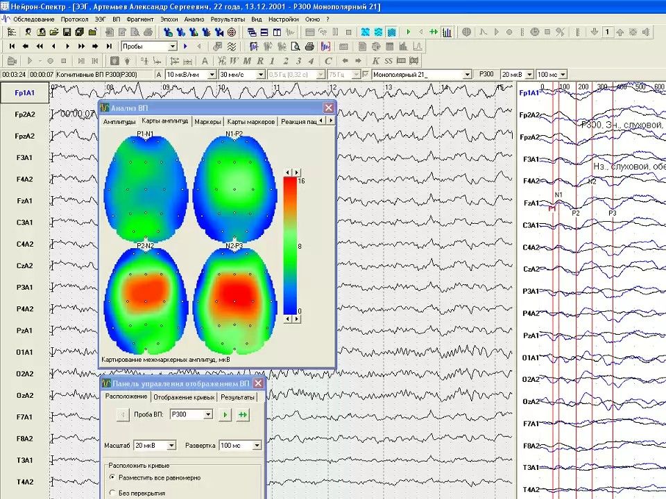 Данные диагностики. Нейрон-спектр-4/ВПМ. Зрительные вызванные потенциалы при рассеянном склерозе. Омега потенциал головного мозга. Исследование вызванных потенциалов при рассеянном склерозе.