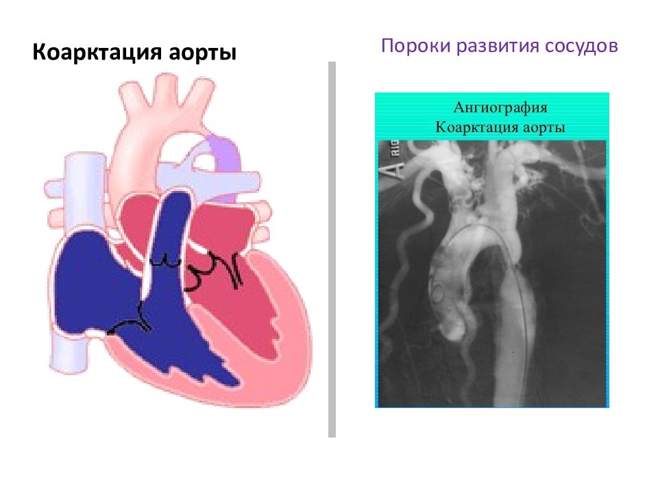 Коарктация аорты картинки