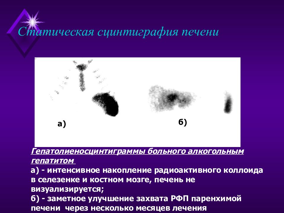 Что такое сцинтиграфия