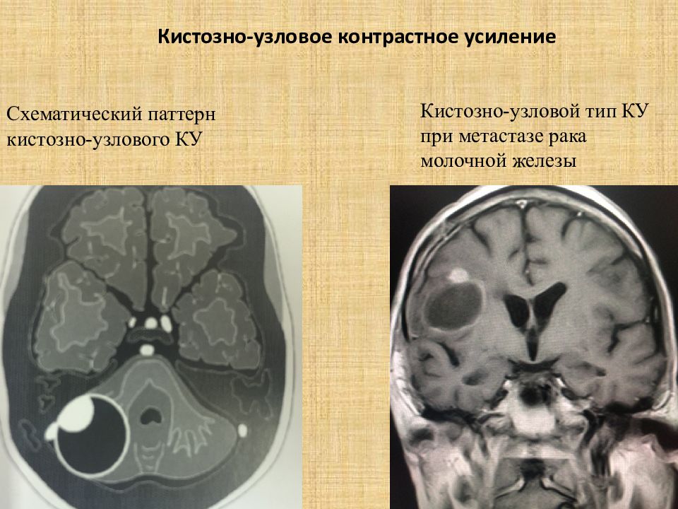Контрастное усиление. Метастатические опухоли головного мозга. Метастазы при контрастном усилении. Болюсное контрастное усиление. Кистозно расширенная железа