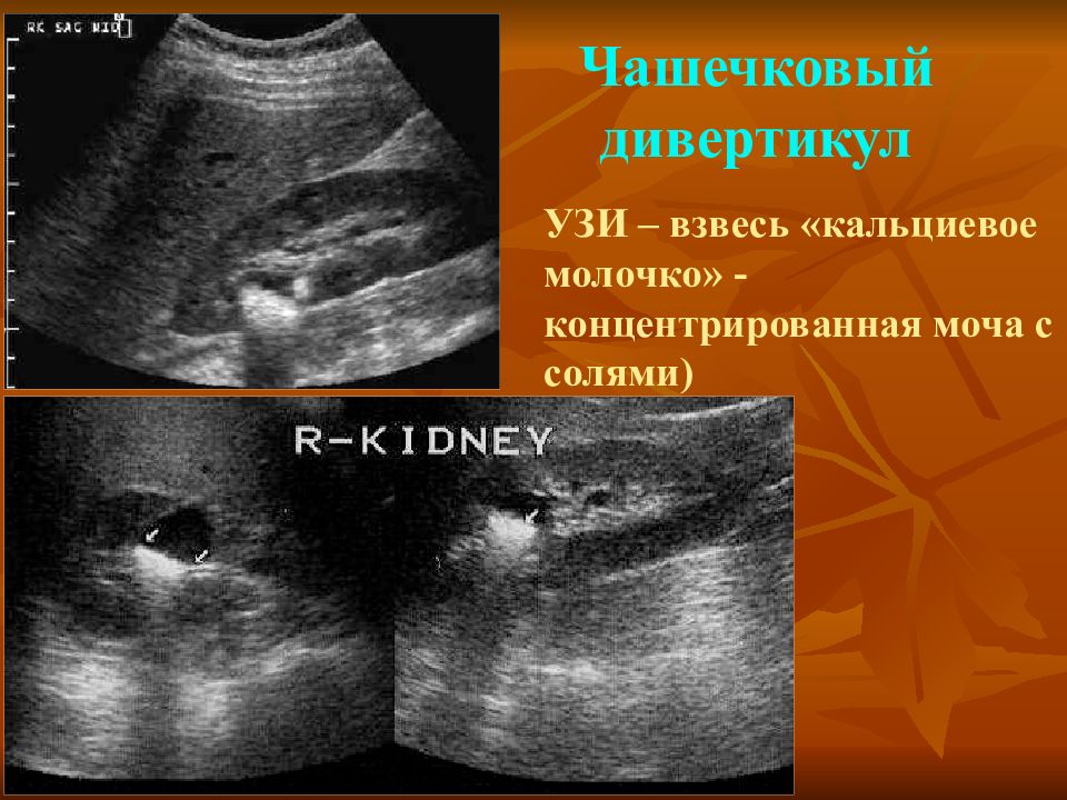 Киста почки мкб 10. Кальциевое молочко УЗИ почек. Дивертикул чашечки в почке УЗИ. Чашечковый дивертикул. Дивертикул чашечки почки.