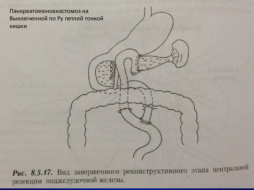 Операция пдр схема