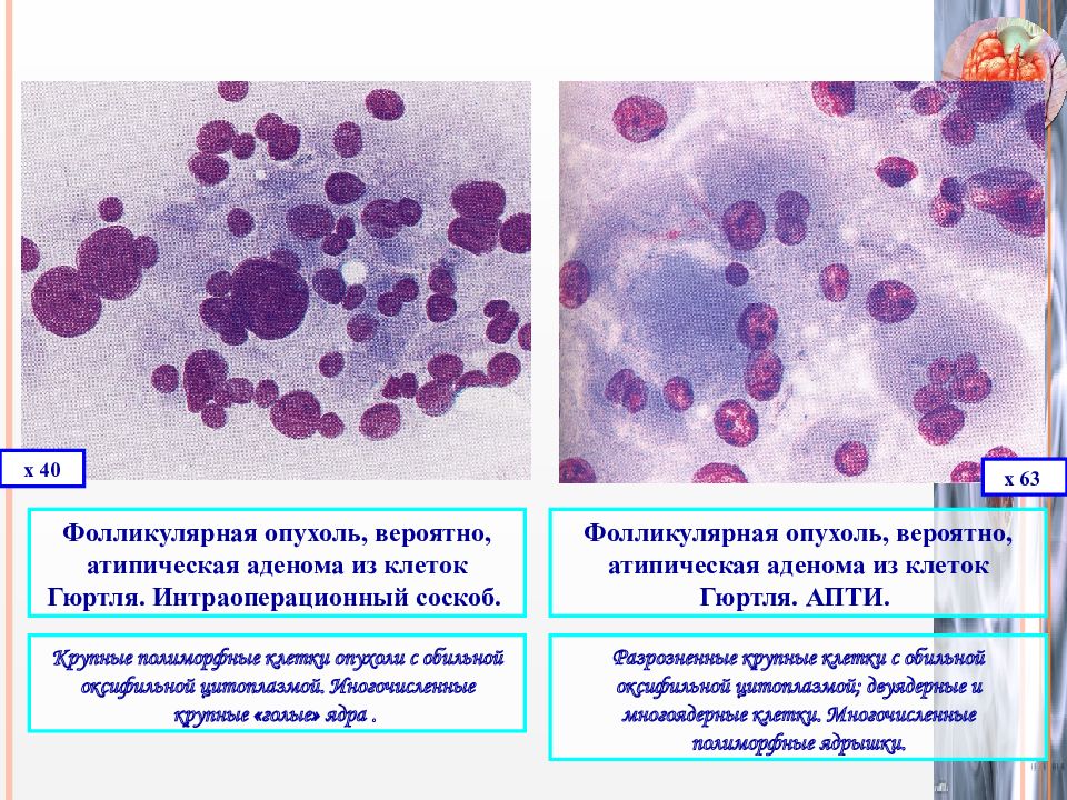 Фолликулярная неоплазия низкой степени щитовидной. Фолликулярная аденома щитовидной железы цитология. Гюртлеклеточная аденома щитовидной железы. Гистологическая классификация опухолей щитовидной железы. Цитологическая картина фолликулярной опухоли.