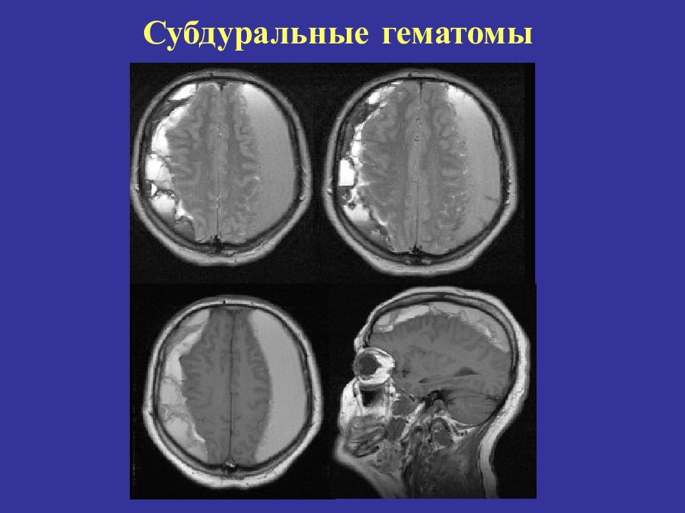 Острая субдуральная гематома клиническая картина