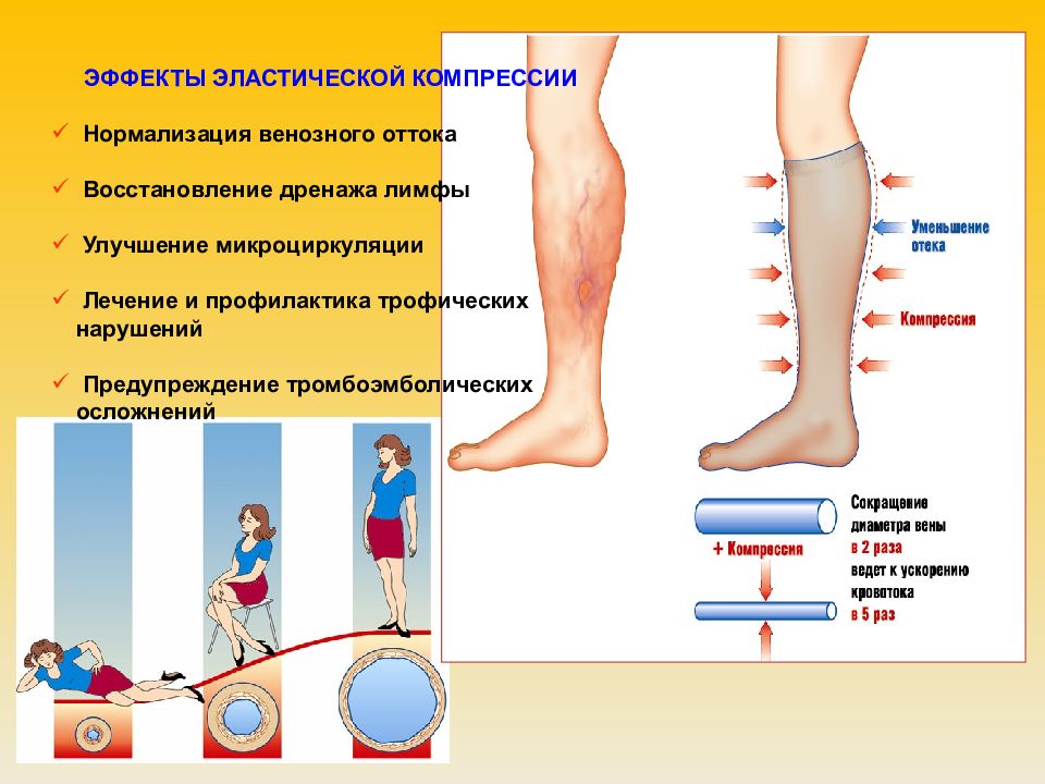 Улучшение венозного оттока. Эластическая компрессия нижних конечностей. Эластичность компрессия нижних конечностей. Эластичная компрессия нижних конечностей алгоритм.