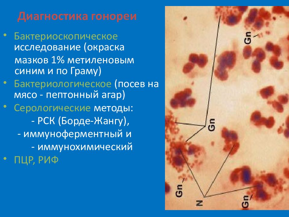 Пцр гонококк. Гонококки окраска метиленовым синим. Гонорея окраска метиленовым синим. Бактериоскопическое исследование при гонорея. Окраска гонококков метиленовым синим.