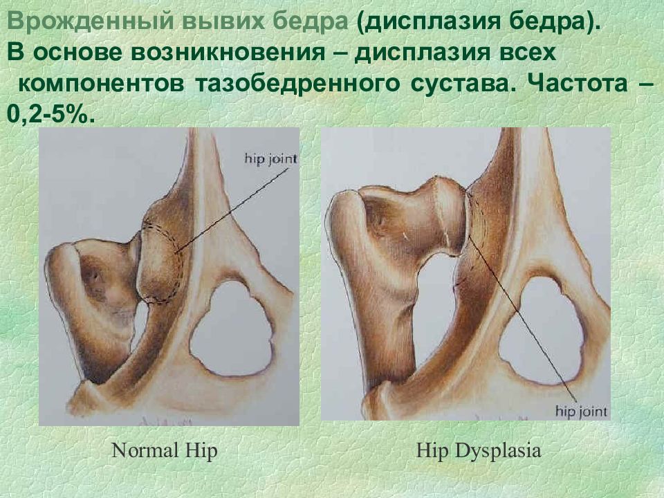 Врожденный вывих бедра. Степени врожденного вывиха бедра. Врожденный вывих бедра (дисплазия бедра). Врожденный вывих бедра классификация.