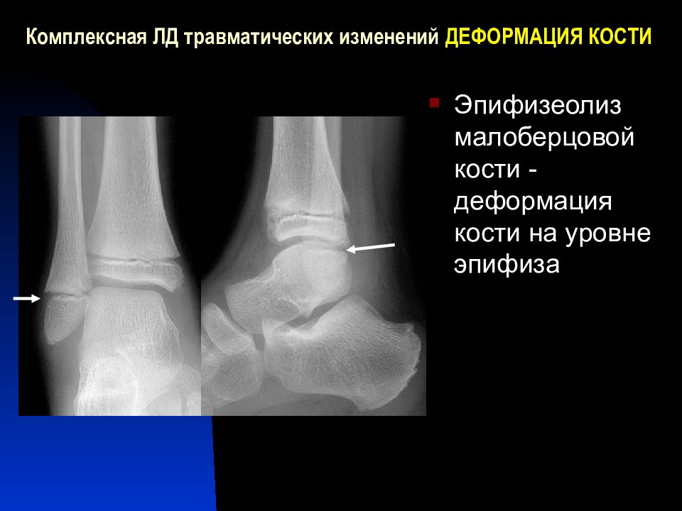 Эпифизеолиз. Наружной лодыжки большеберцовой кости эпифизеолиз. Эпифизеолиз дистального метаэпифиза малоберцовой кости. Дистальный эпифизеолиз малоберцовой кости. Дистальный эпифизеолиз правой лучевой кости.