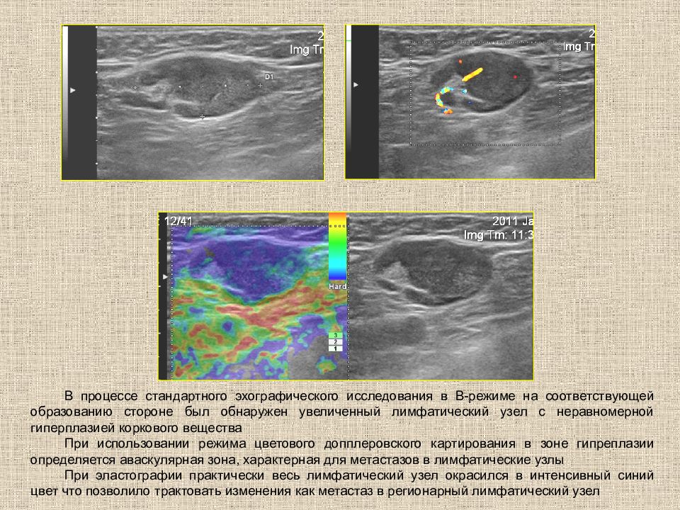 Эхографической картиной характеризующей липоматозный узел является