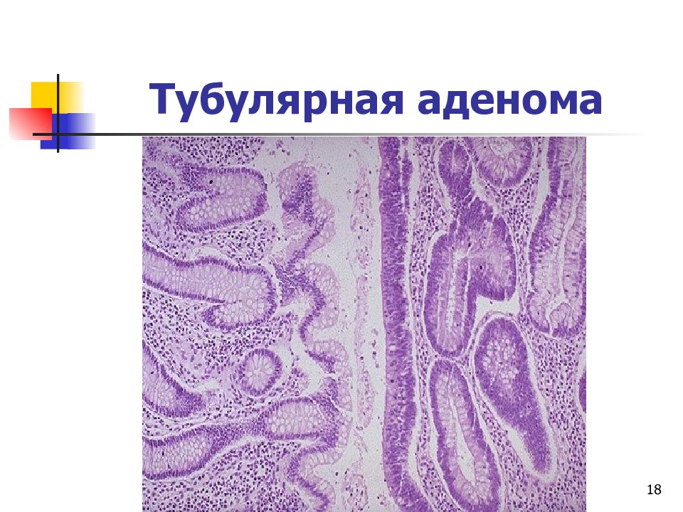 Аденома с высокой неоплазией. Тубулярная аденома толстой кишки гистология.