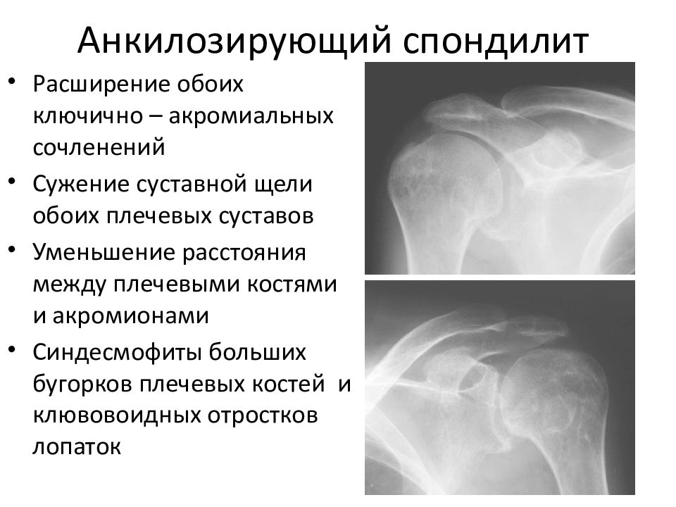 Акромиально ключичных сочленений 1 ст. Анкилозирующий спондилит синдесмофиты. Артроз плечевого сустава рентген протокол. Акромиально-ключичное сочленение рентген норма. Суставная щель акс.