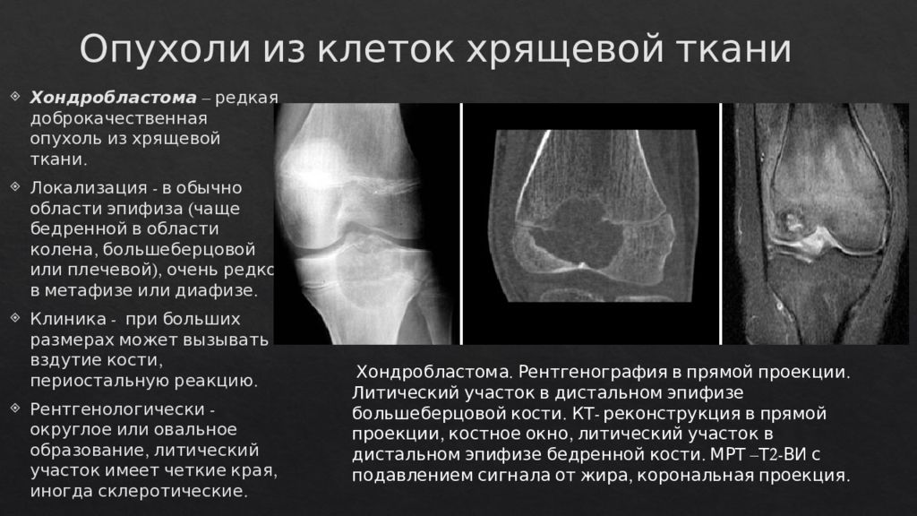 Диагностика опухоли кости. Хондробластома бедренной кости кт. Доброкачественная опухоль хрящевой ткани. Опухоли бедренной кости мрт. Опухоль кости энхондрома.