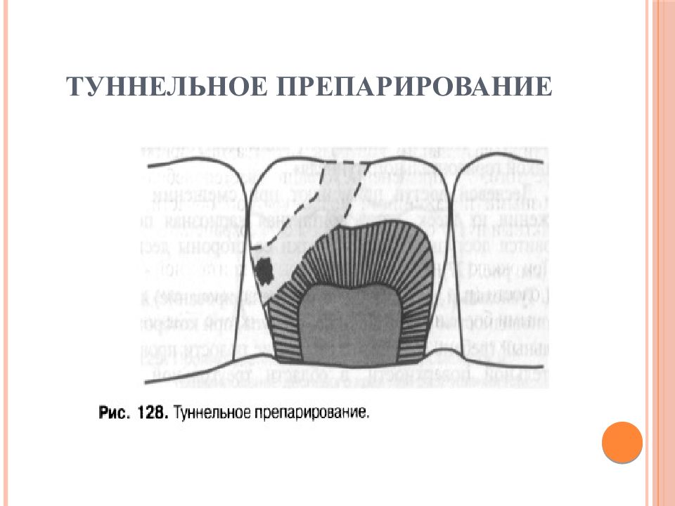 Полость готовиться. Туннельный метод препарирования зубов. Туннельное препарирование кариозной полости. Туннельный метод препарирования кариозной полости. Туннельное препарирование кариозной полости 2.