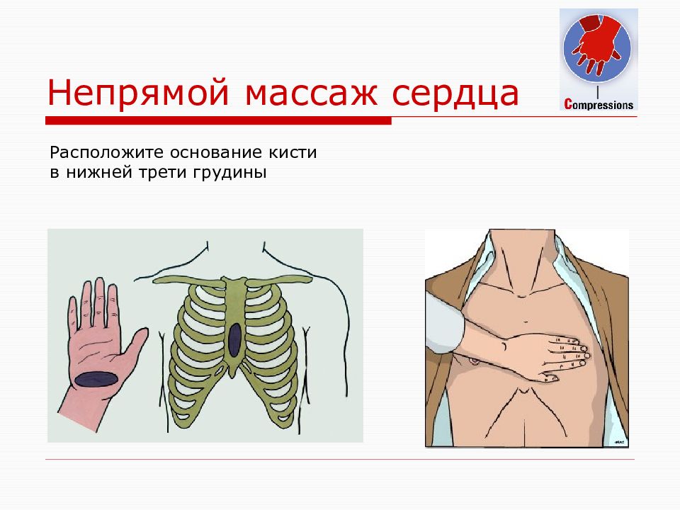 Непрямой массаж сердца. Положение рук при непрямом массаже сердца. Положение рук при массаже сердца. Расположение рук при непрямом массаже сердца. Расположение рук при массаже сердца.