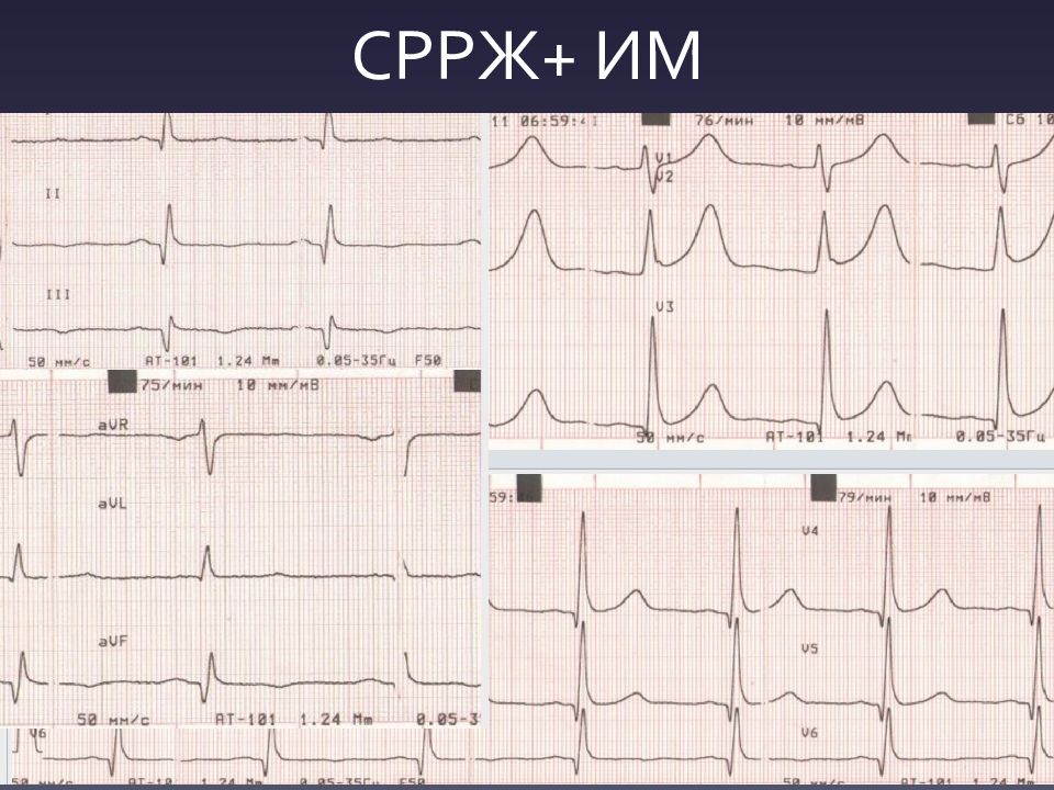 Реполяризация нижней стенки. СРРЖ. СПРЖ на ЭКГ. Стадия реполяризации. Снижение реполяризации.