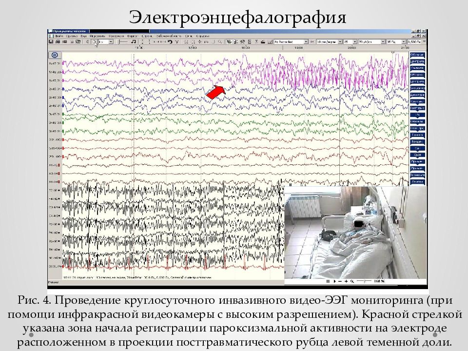 Какой врач лечит эпилепсию. Инвазивный ЭЭГ мониторинг. Инвазивный видео ЭЭГ мониторинг. Пароксизмальная активность на ЭЭГ. Монитор ЭЭГ.