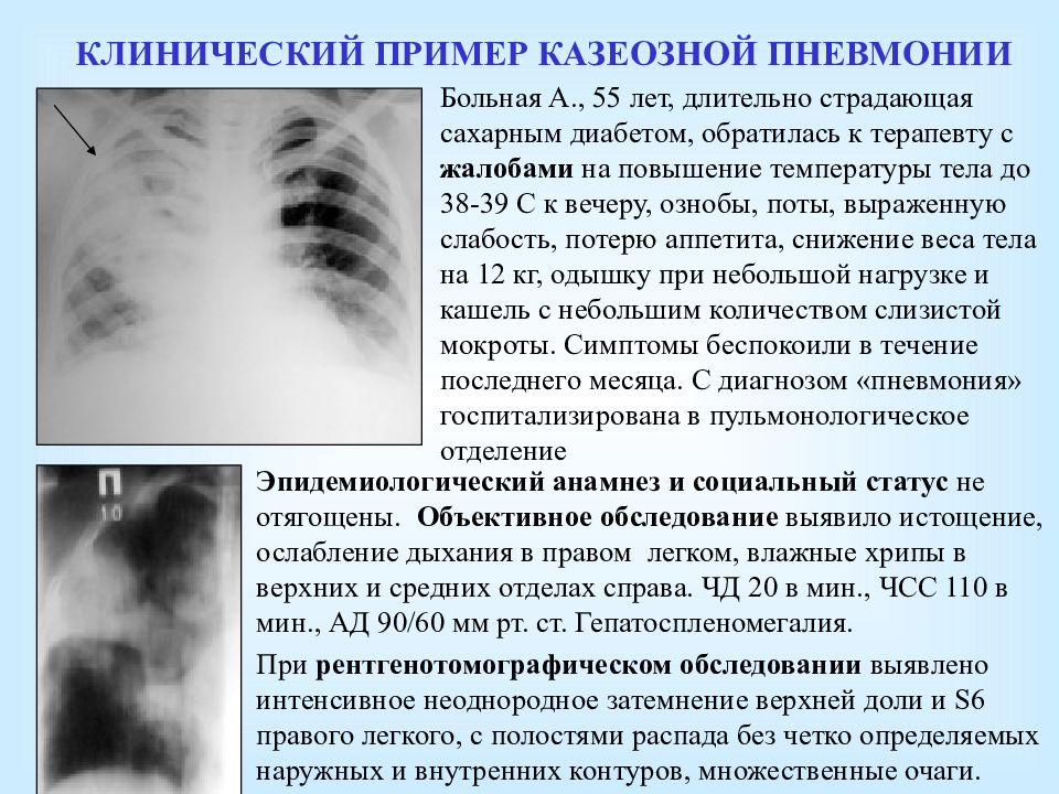 После пневмонии легочный рисунок усилен