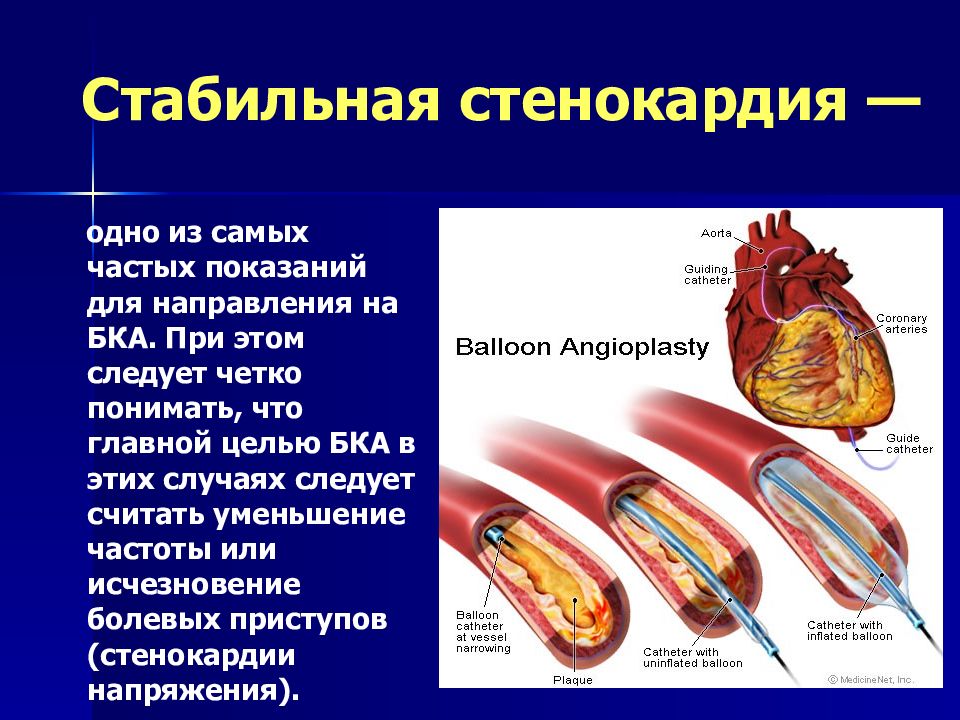 Стабильная стенокардия что это. Стабильная стенокардия. Стабилное стенокардия. Ишемическая болезнь сердца стабильная стенокардия.