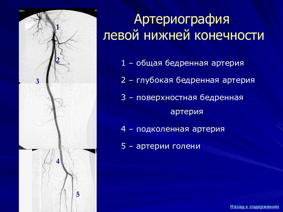 Артерии голени кт ангиография. Ангиография подколенной артерии. Сосуды голени кт анатомия. Артерии нижних конечностей кт анатомия.