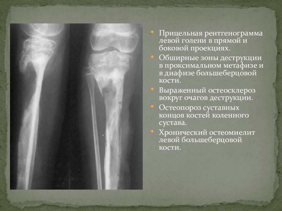 Очаговые изменения костей. Остеопороз большеберцовой кости рентгенограмма. Остеопороз перелом большеберцовой кости. Остеопороз на рентгене большеберцовой. Остеосклероз голени рентген.