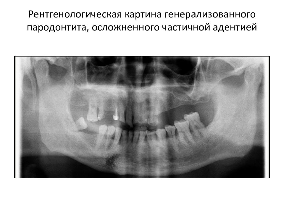 Этиология патогенез клиника заболеваний пародонта презентация